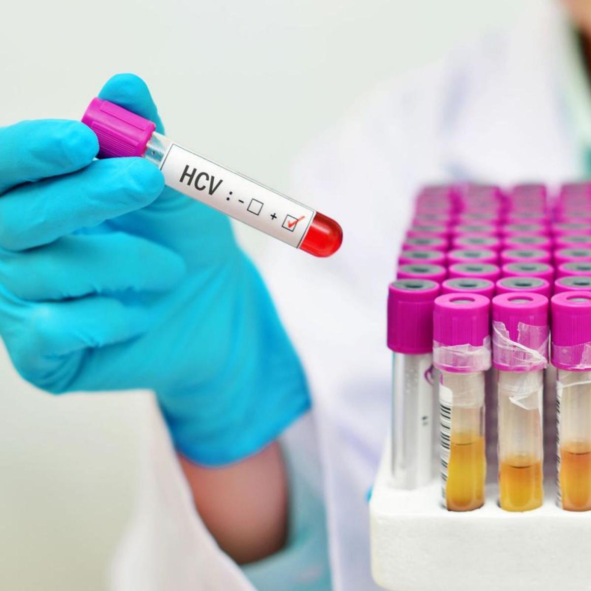 Espanya, a punt de ser pionera en l’eliminació de l’hepatitis C Espanya, a punt de ser pionera en l’eliminació de l’hepatitis C
